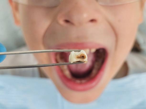 Best Emergency Tooth Extraction in Diboll, TX